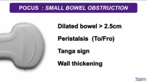 small bowel obstruction image