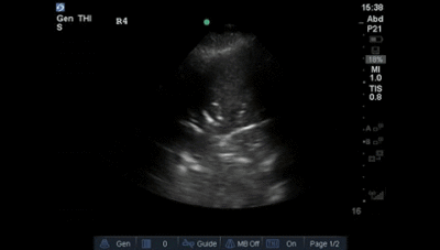 Lung – Dynamic air bronchograms_1 – Western Sono